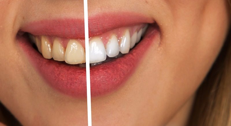11 Things That Stain Your Teeth The Most - How to Minimise Staining? - Tech Urdu